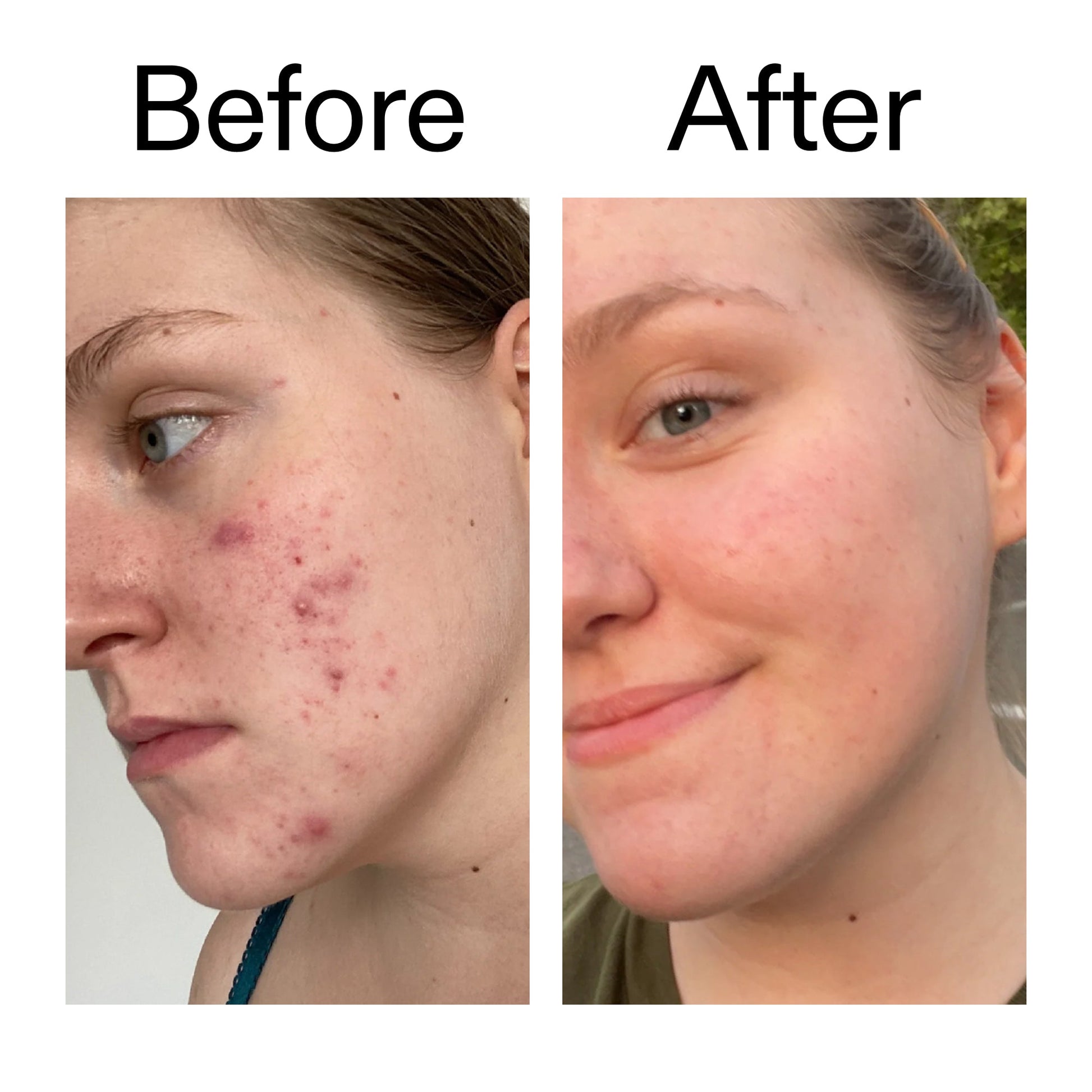 15-vitamin-c-egf-serum-x0 15_Vitamin_C_EGF_Serum_Before_After_2000x2000_fb9f598a-3386-40c8-8143-36f9d7a17ec8.jpg