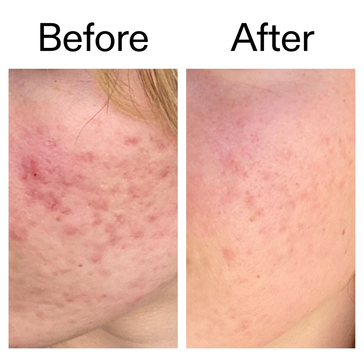 10-azelaic-acid-serum-for-redness-relief-p6 Azealic_Acid_Serum_B_A_Ppage_2000_x_2000.jpg