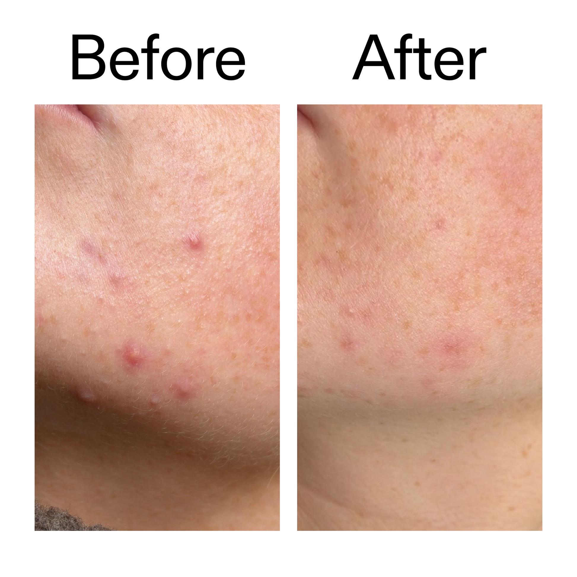 10-azelaic-acid-serum-for-redness-relief-p6 B_A_1_PPAGE.png
