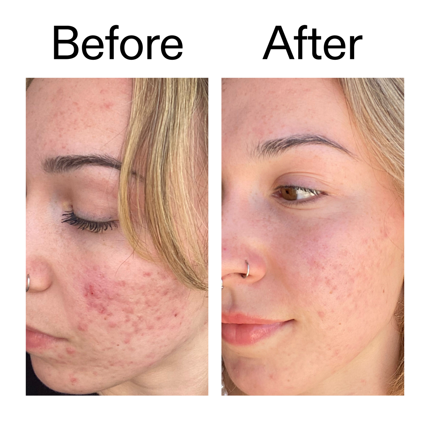 10-azelaic-acid-serum-for-redness-relief-p6 B_A_2_PPAGE.png