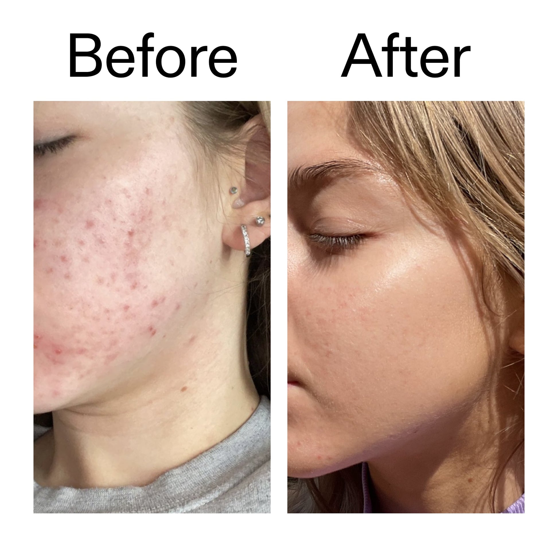 beta-hydroxy-acid-bha-serum-q3 Beta_Hydroxy_Acid_Serum_Before_After_2000x2000_96fda3e5-938d-49ef-bcf2-a0fa6ece4e2c.jpg