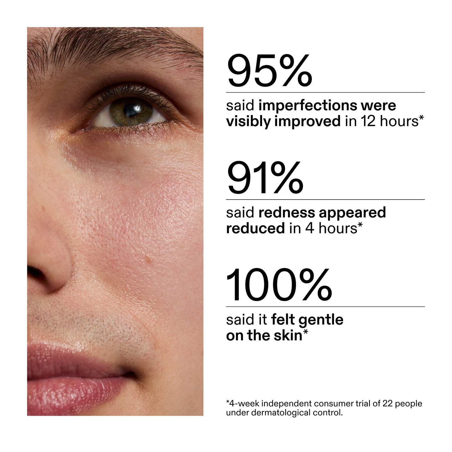succinic-acid-acne-treatment-x2 CA_Succinic_Acid_Treatment_key_Claims_2000x2000_db91b0f1-7f29-4bfe-bb16-63a47f500960.jpg