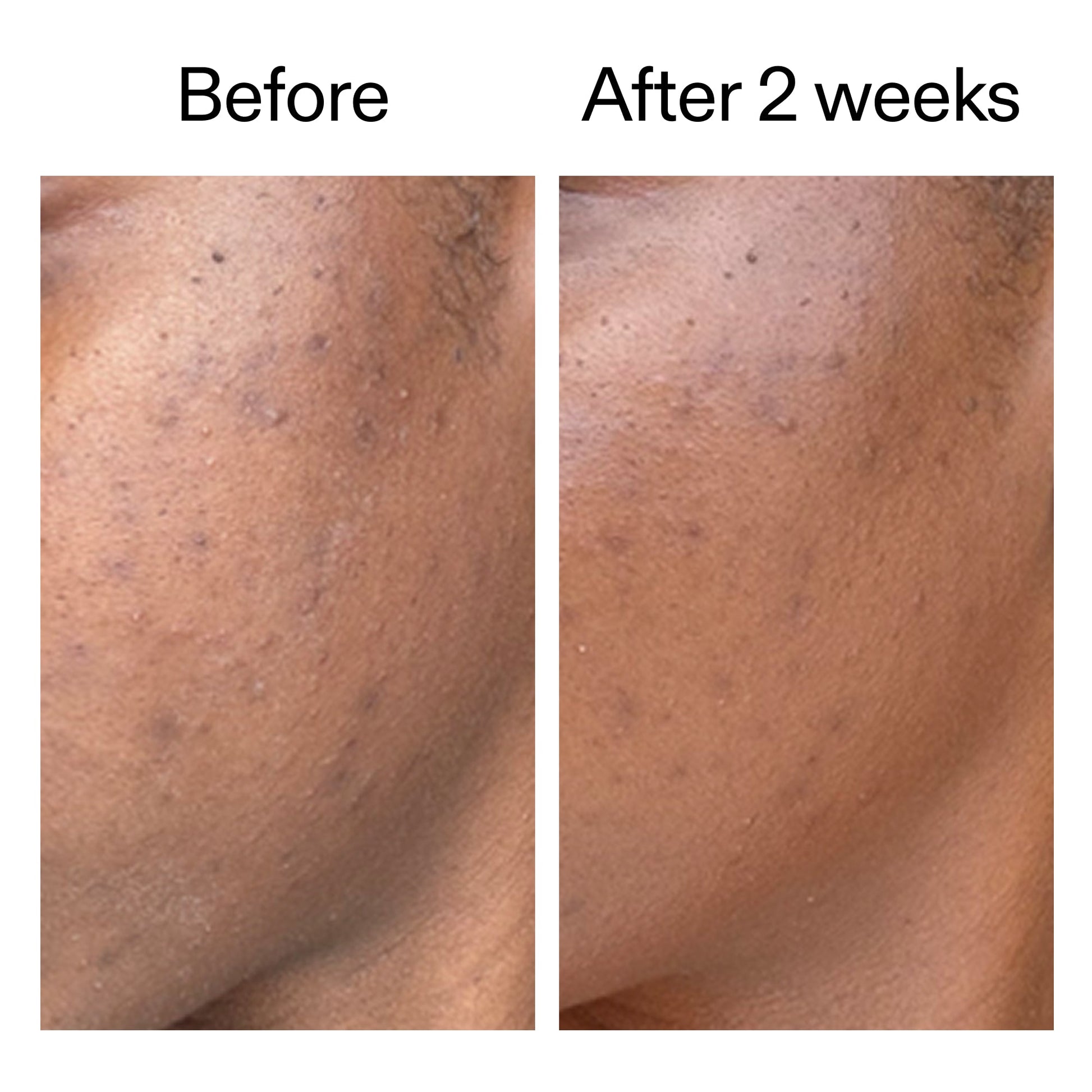360-acne-clearing-serum-a6 DIOICB_A2000x2000.jpg
