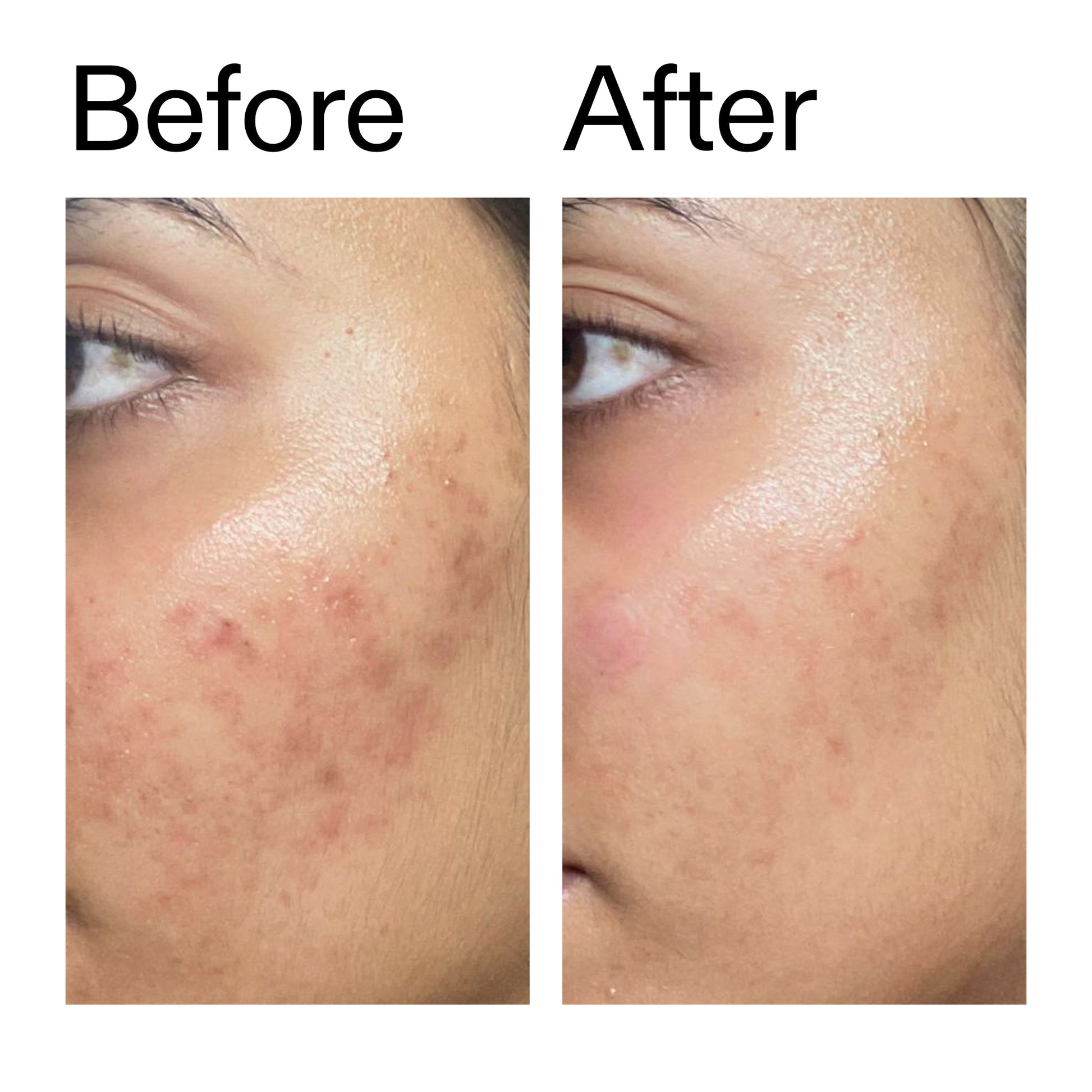 ectoin-hydro-barrier-serum-duo-o7 Ectoin_Hydro-barrier_Serum__Before_After_2000x2000_34261920-d004-48d0-9c7b-8e1c15971bfd.jpg