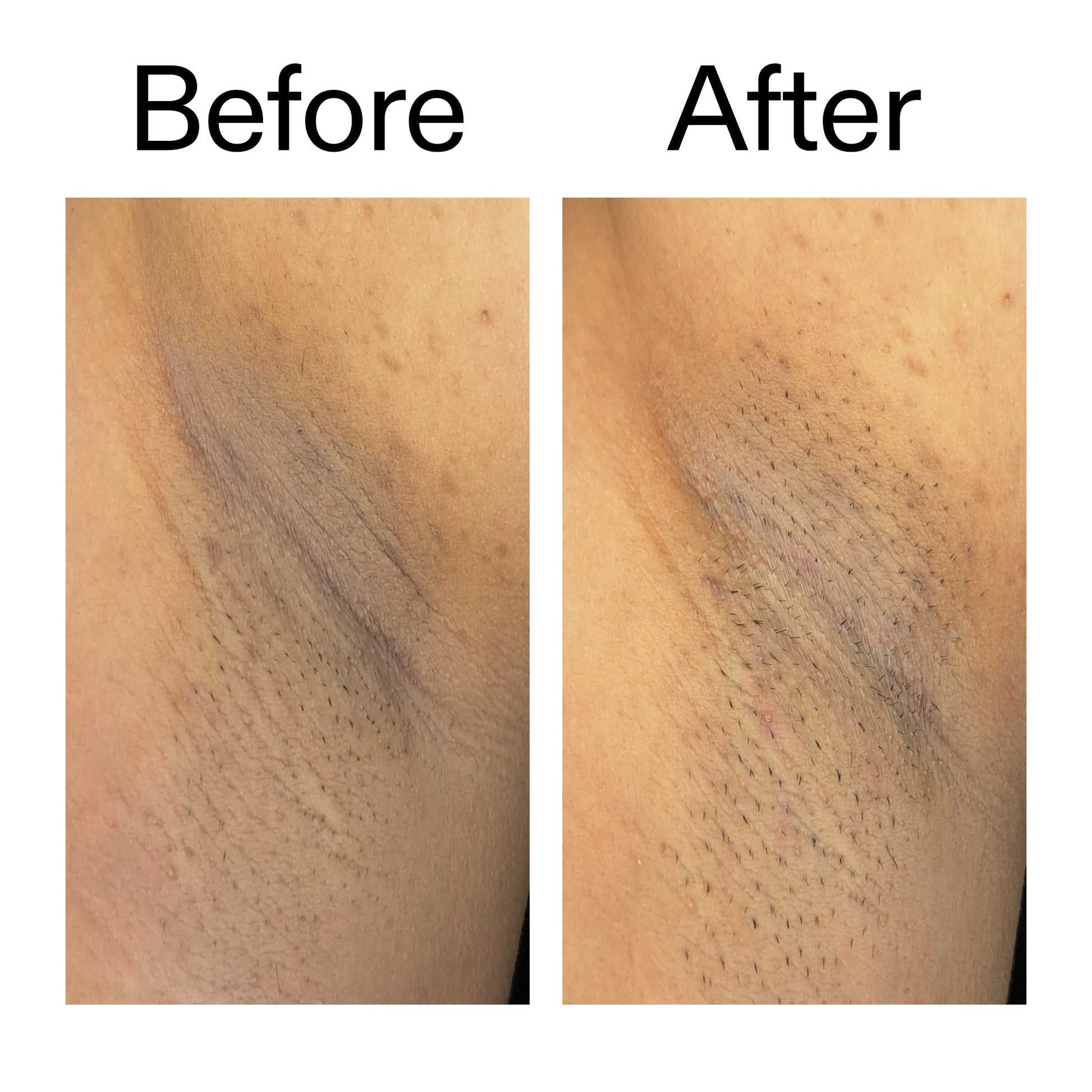 glycolic-acid-exfoliating-body-stick-b7 Glycolic_Acid_Exfoliating_Body_Stick_Before_After_V3_2000x2000_ea919cd9-1439-4a46-82a0-76200eb5bb42.jpg