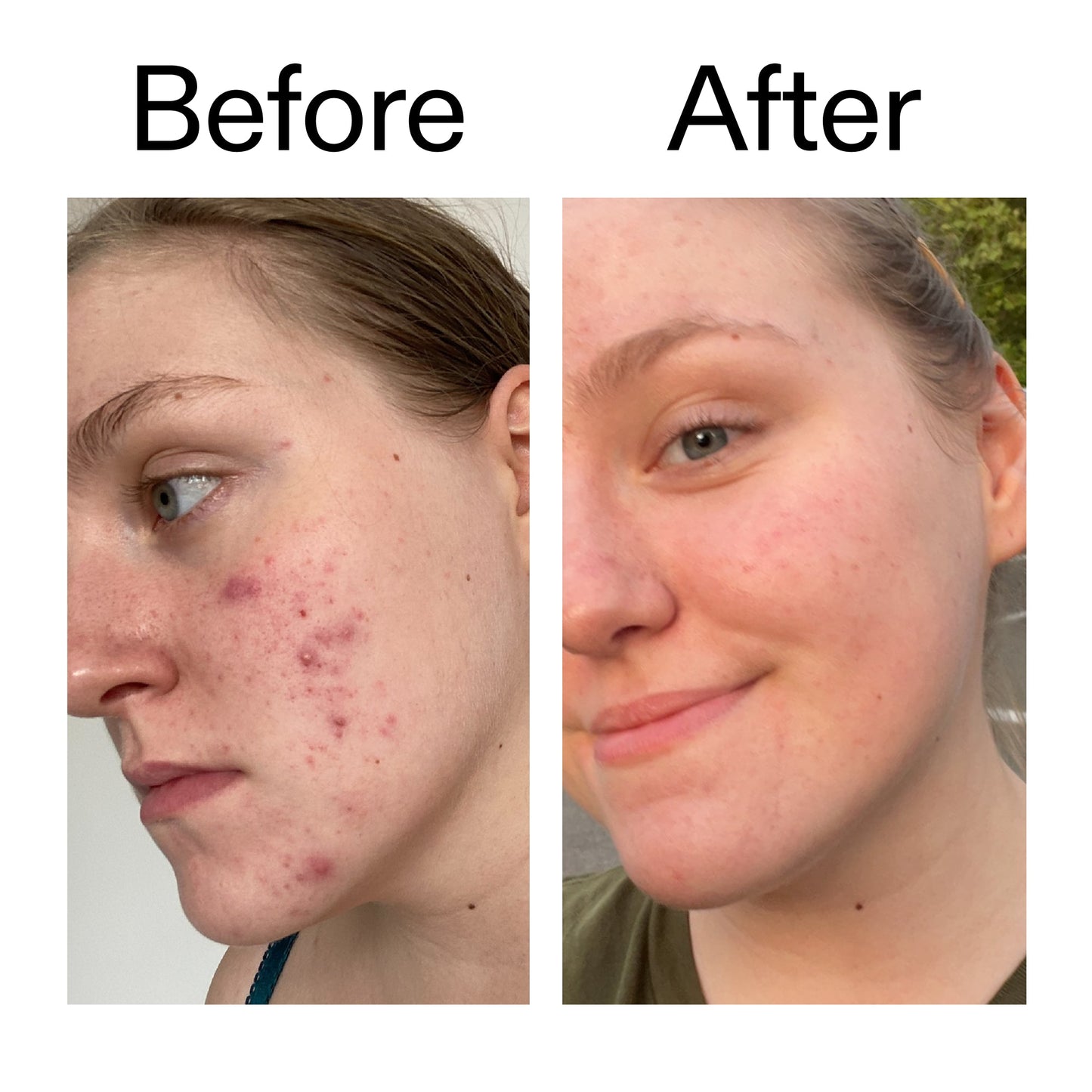 glycolic-acid-toner-w1 Glycolic_Acid_Toner_Before_After_2000x2000_49f0b9f7-e71b-4b2e-a8f8-2ea4b73247bb.jpg