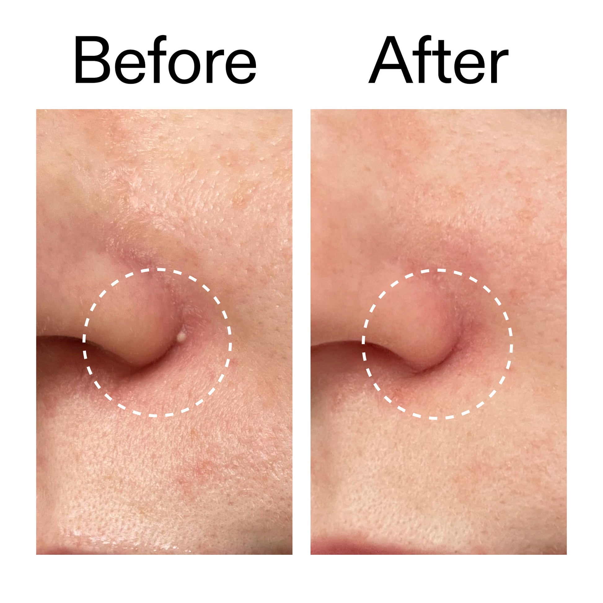 hydrocolloid-invisible-pimple-patches-pack-of-44-b4 Hydrocolloid_Invisible_Pimple_Patches_Before_After_2000x2000_b02aa37b-c78a-4682-91de-9135af5bb7df.jpg