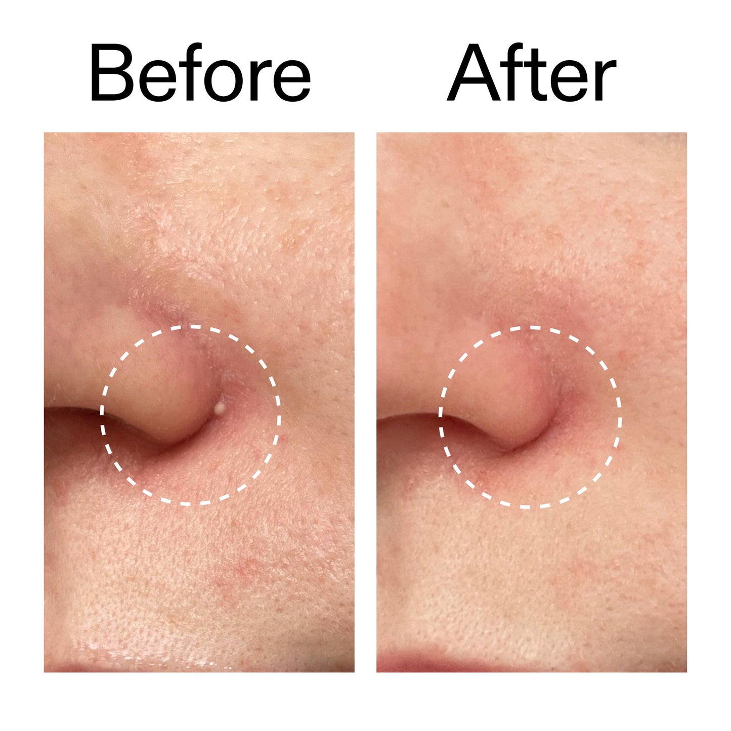 hydrocolloid-invisible-pimple-patches-pack-of-22-k8 Hydrocolloid_Invisible_Pimple_Patches_Before_After_2000x2000_b02aa37b-c78a-4682-91de-9135af5bb7df.jpg