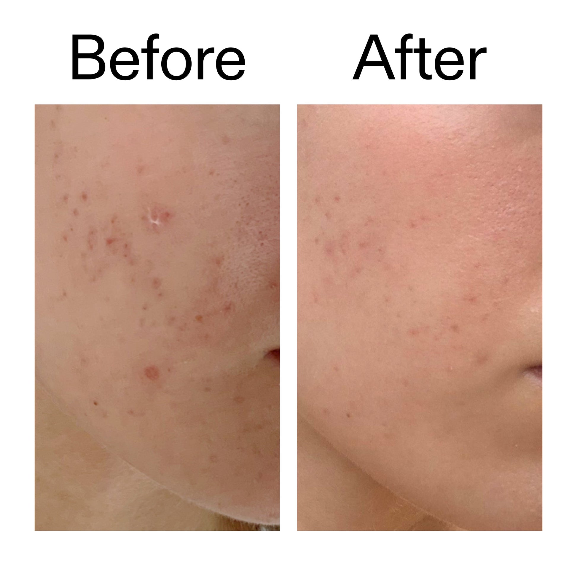mandelic-acid-treatment-w6 Mandelic_Acid_Treatment_Before_After_2000x2000_4885ac6e-c5d7-4279-a72a-1417af7dce35.jpg