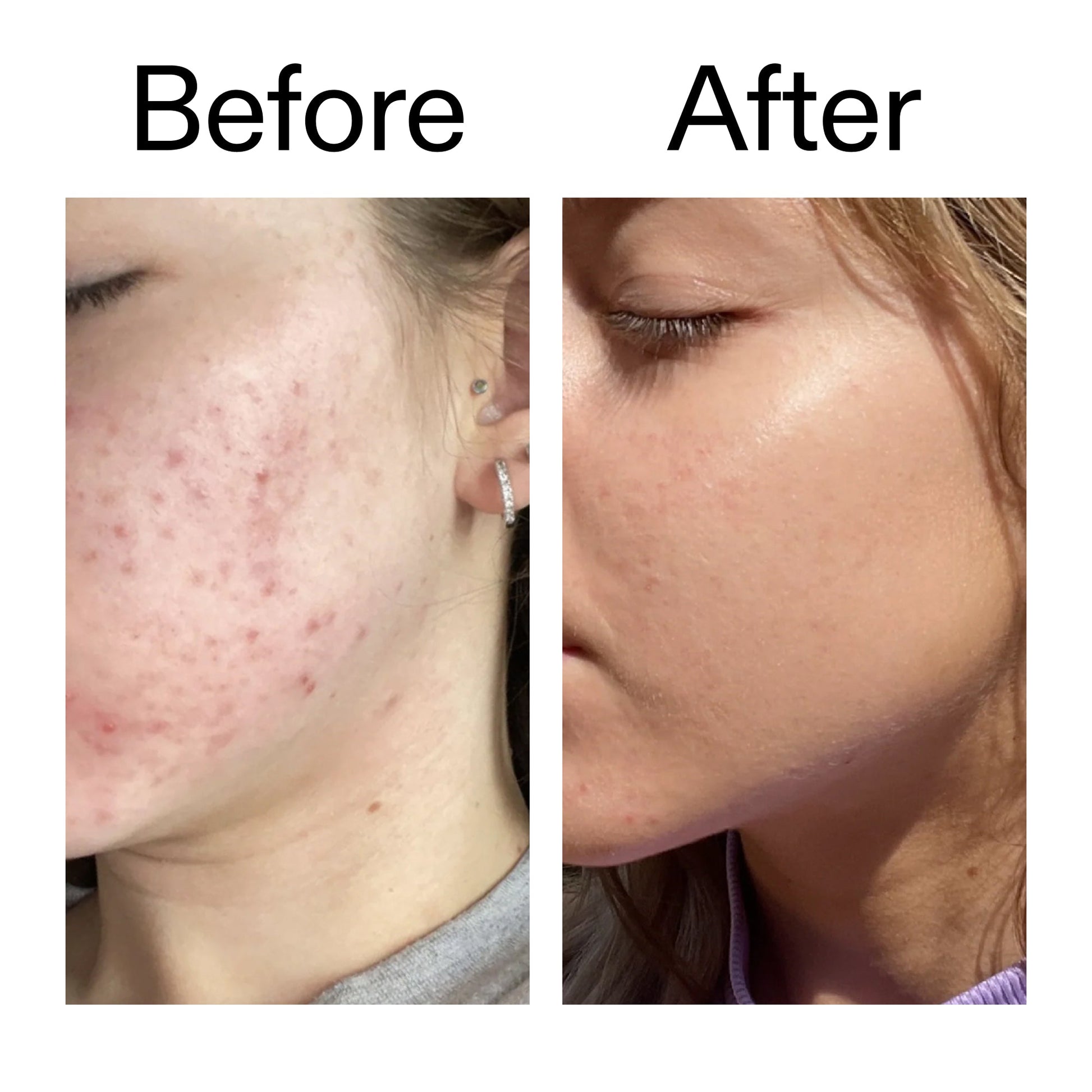 10-niacinamide-serum-r0 Niacinamide_Serum_Before_After_2000x2000_bde32455-9e7d-448e-b053-bef41504f0a9.jpg