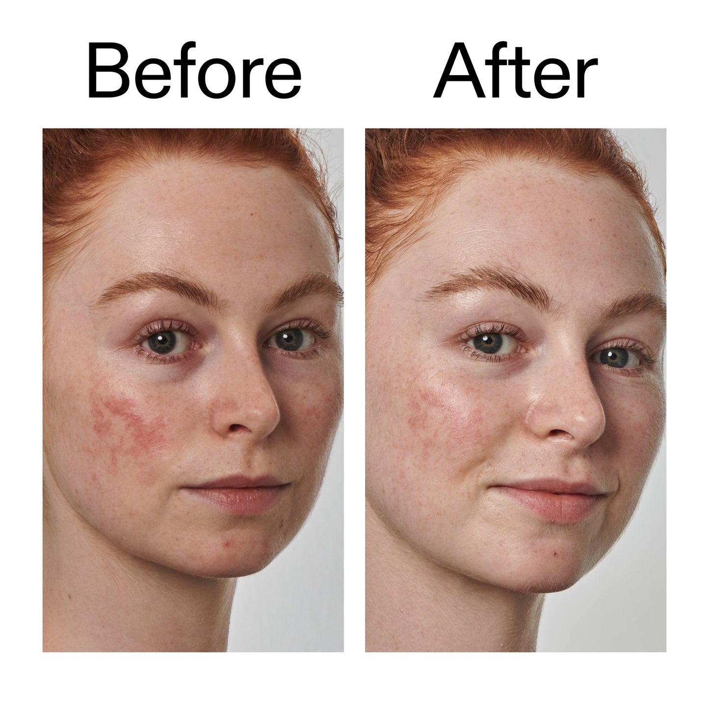 10-azelaic-acid-serum-for-redness-relief-p6 Redness_Relief_Serum_Before_After_2000x2000_3334dc9a-cce9-4e00-8aec-7ad89ca051f2.jpg
