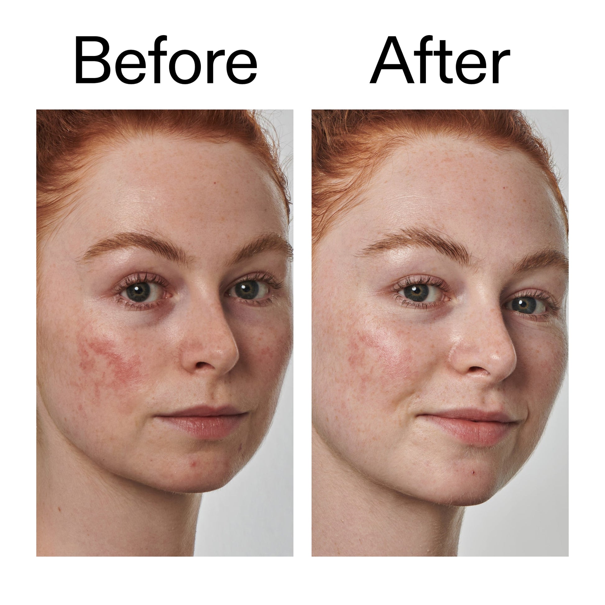 10-azelaic-acid-serum-for-redness-relief-p6 Redness_Relief_Serum_Before_After_2000x2000_3334dc9a-cce9-4e00-8aec-7ad89ca051f2.jpg