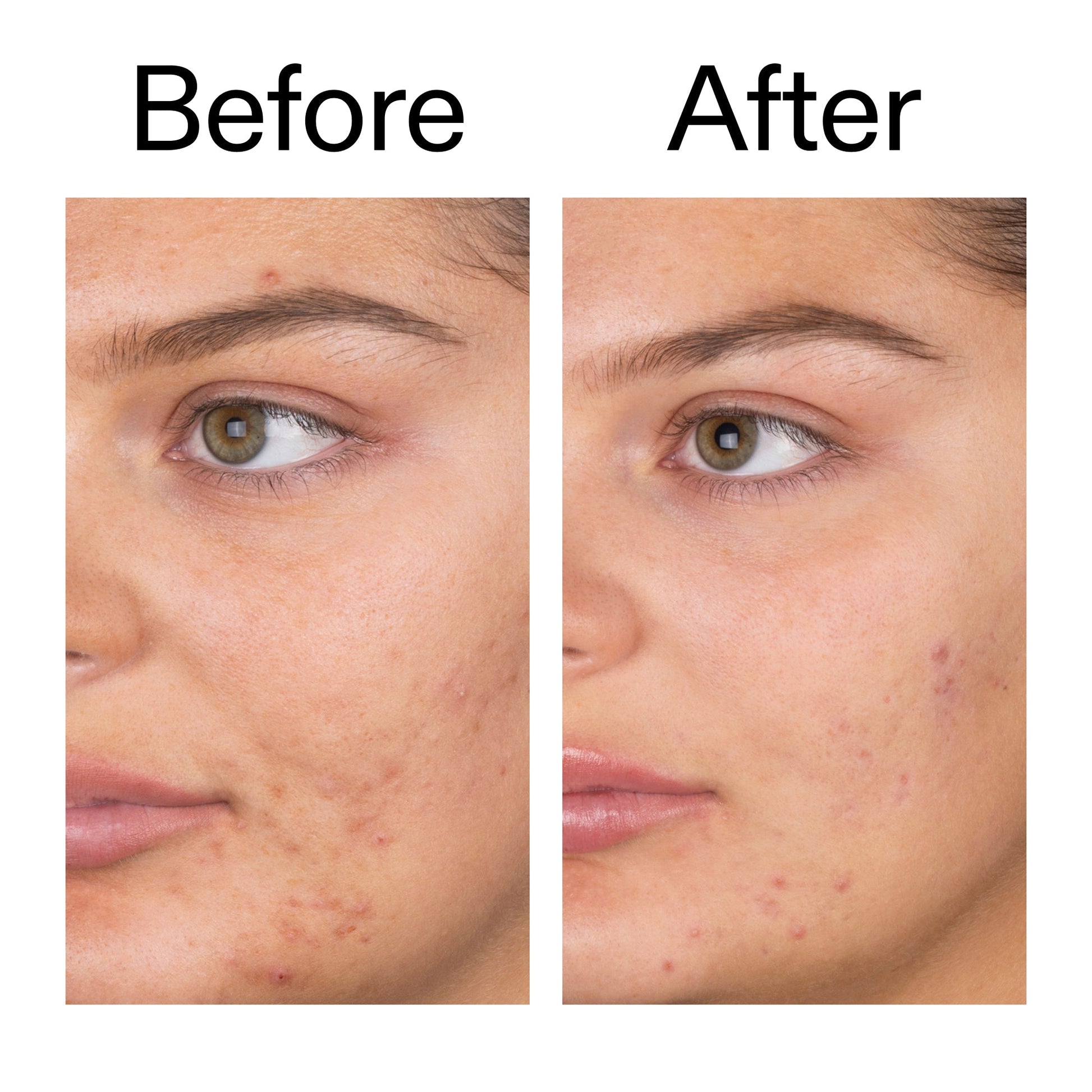 salicylic-acid-cleanser-150ml-d2 Salicylic_Acid_Cleanser_-_150ml_Before_After_2000x2000_e7230494-853f-4b07-82b1-27669104c995.jpg