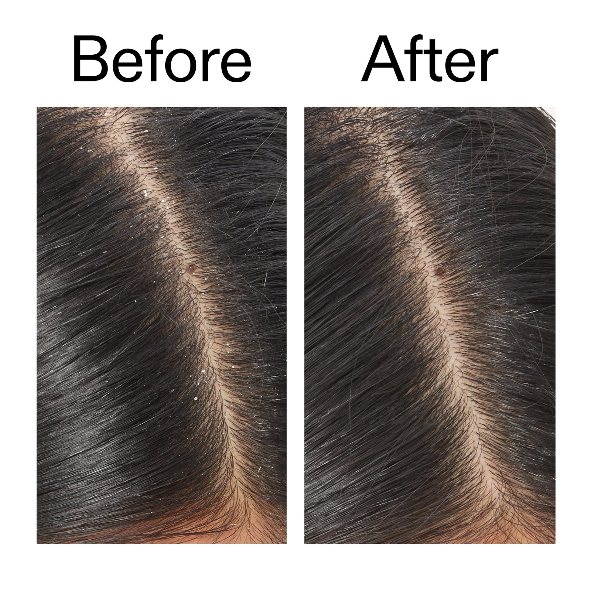 salicylic-acid-exfoliating-scalp-treatment-b8 Salicylic_Acid_Exfoliating_Scalp_Treatment_Before_After_V2_2000x2000_02bd61ad-42bf-490b-b3e3-7e04b2e8a673.jpg