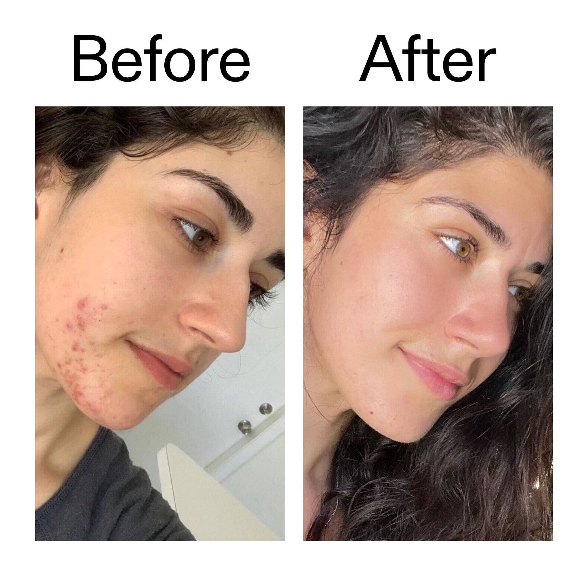 succinic-acid-acne-treatment-x2 Succinic_Acid_Treatment_Before_After_2000x2000_6a5f0054-2f58-4433-9314-0dc72c9bdd3b.jpg