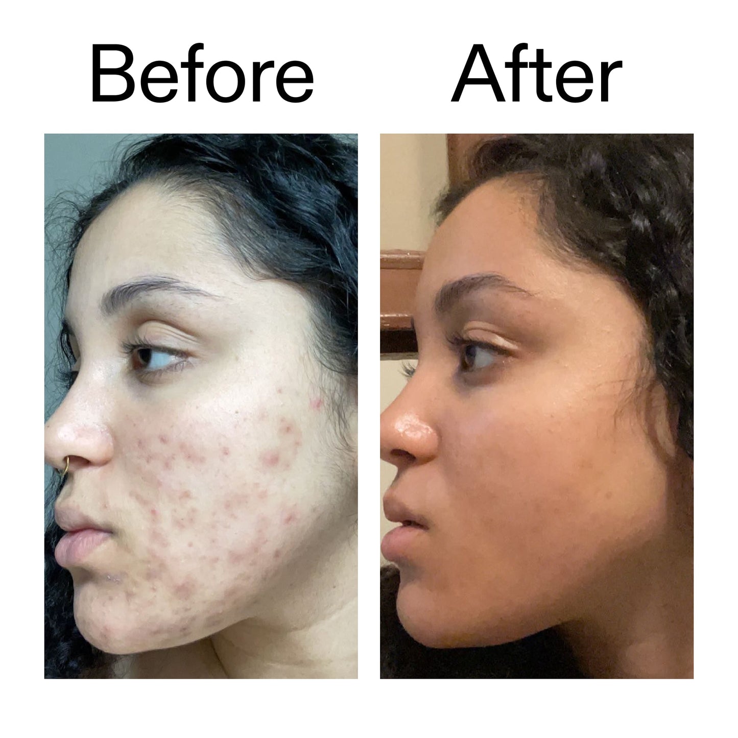 tranexamic-acid-serum-o3 Tranexamic_Acid_Serum_Before_After_2000x2000_98ebc8be-77b0-4843-8a22-90790ebe918b.jpg